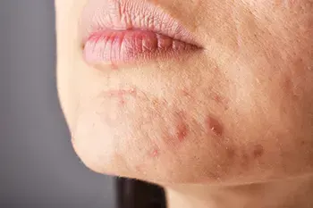 como eliminar manchas de acne en la piel