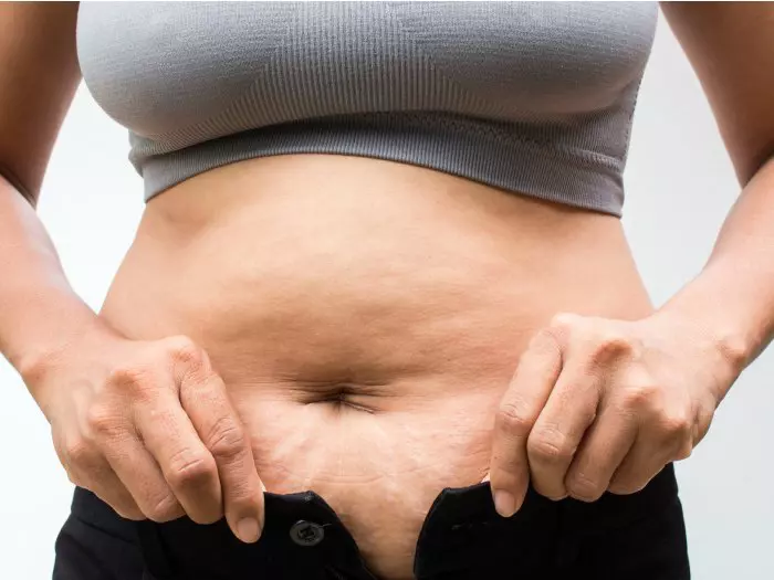 Celulitis abdomen