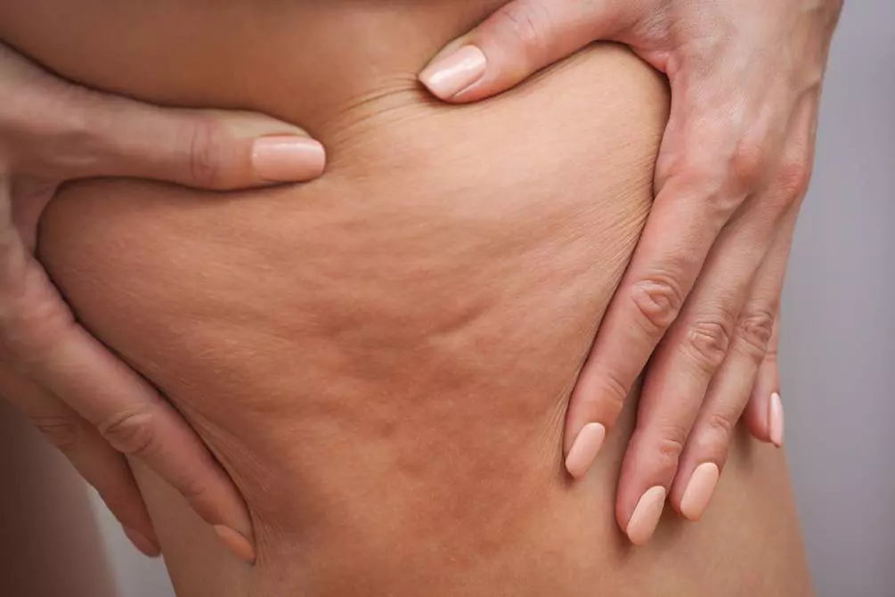 Celulitis en piernas