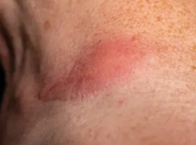 picadura-de-araña