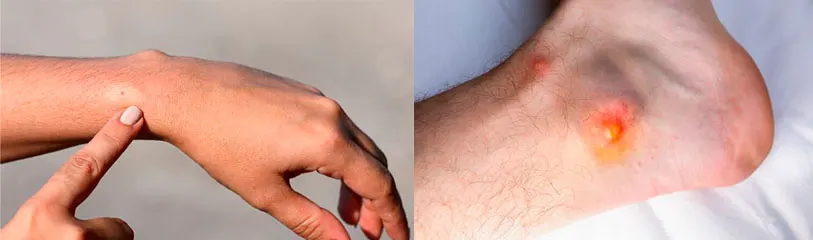 picadura-de-avispa-infectada
