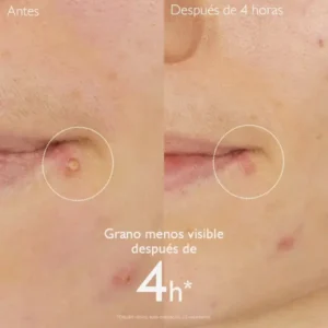 vinopure stop granos con acido salicílico 15 ml