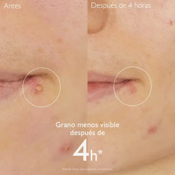 vinopure stop granos con acido salicílico 15 ml